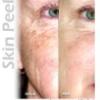 Facial peel