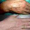 Body peel